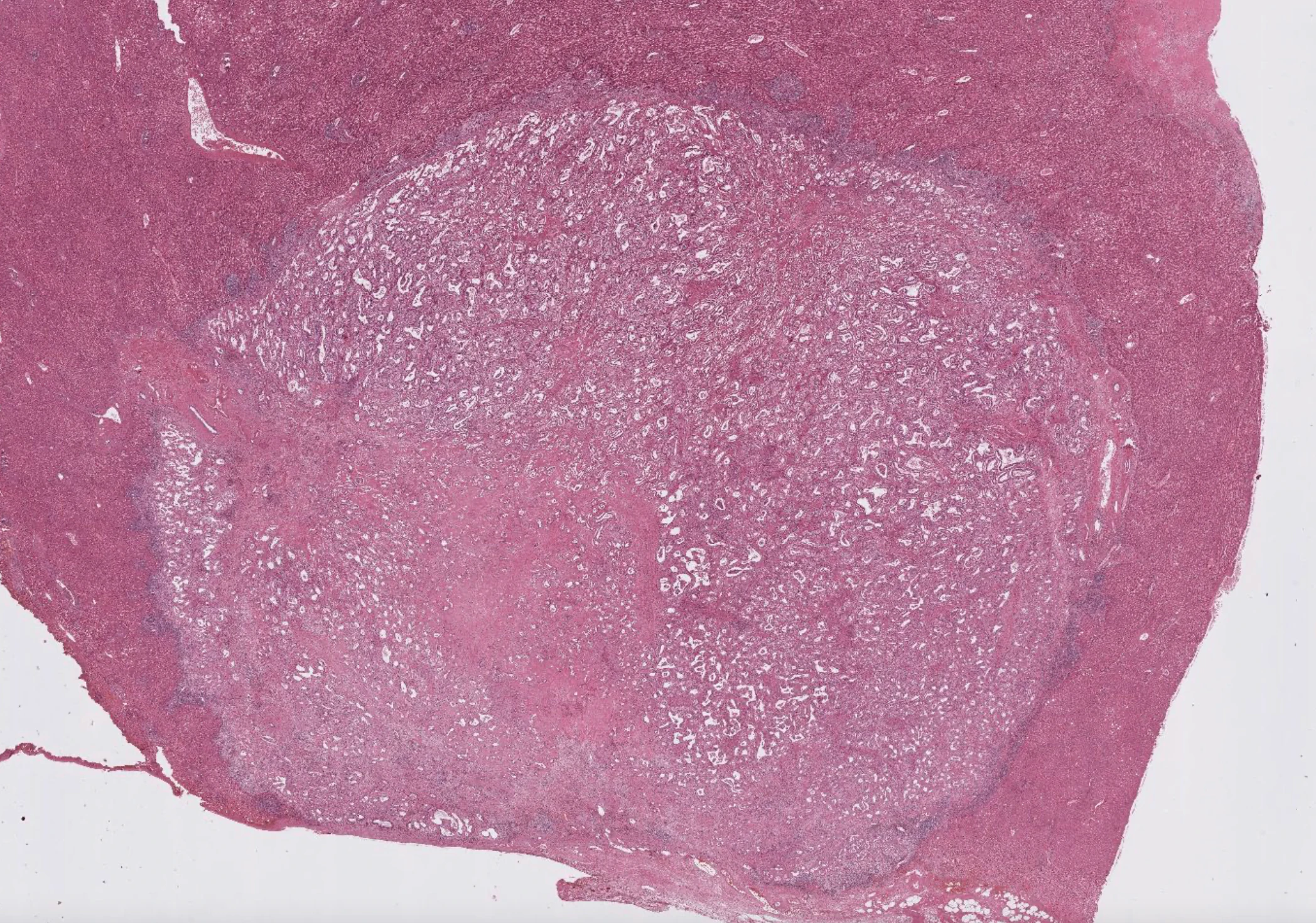Whole slide H and E of liver tumour tissue