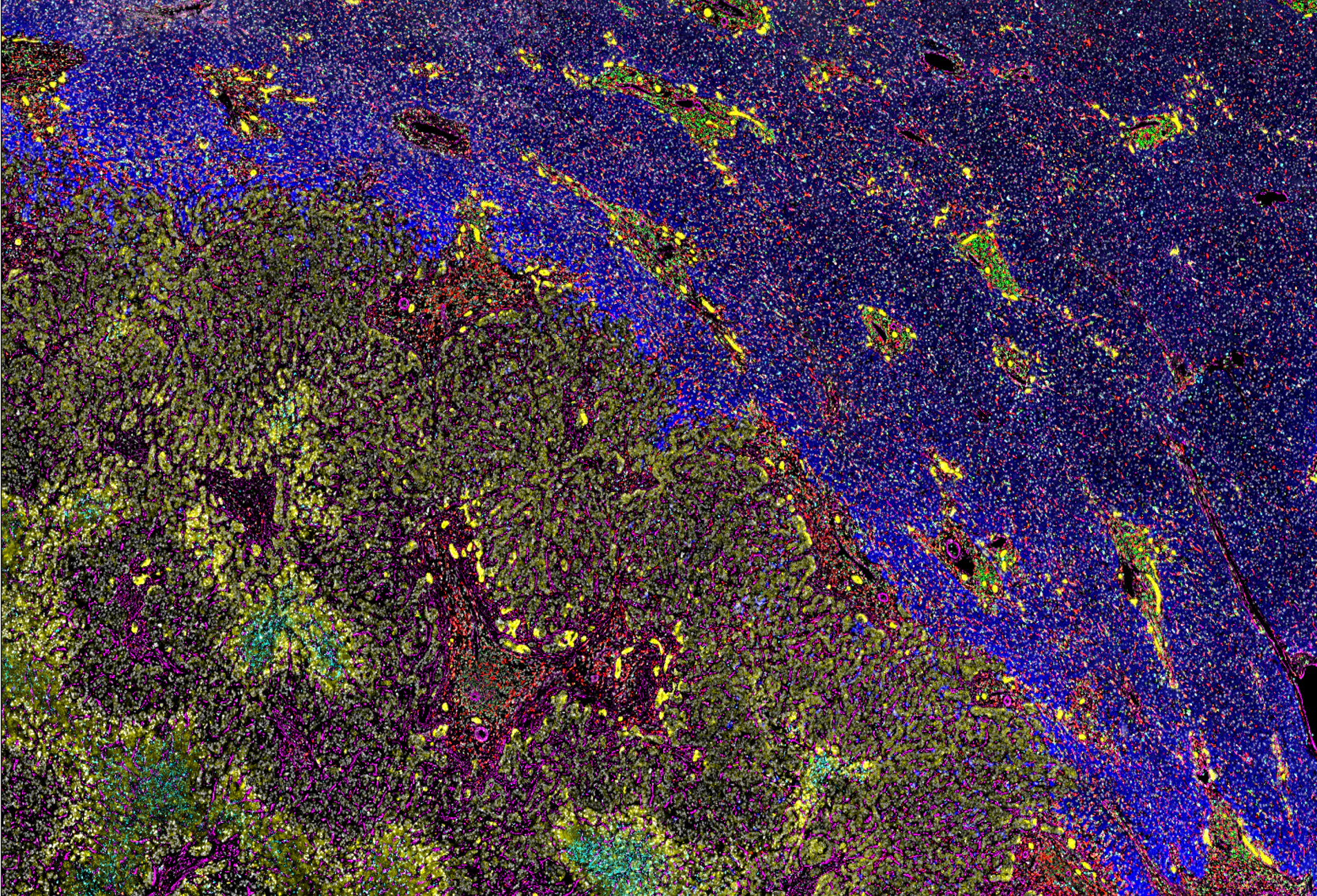 Multiplex immunofluorescence of the tumour-liver interface