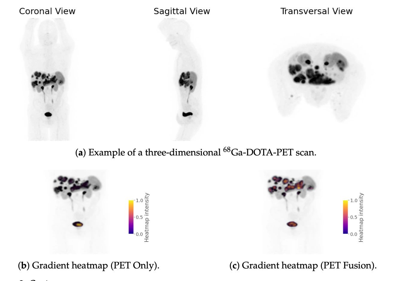 Three dimensional PET scan with gradient heatmap analysis